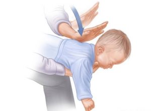 novas-diretrizes-de-associacao-medica-mudam-manobras-de-desengasgo